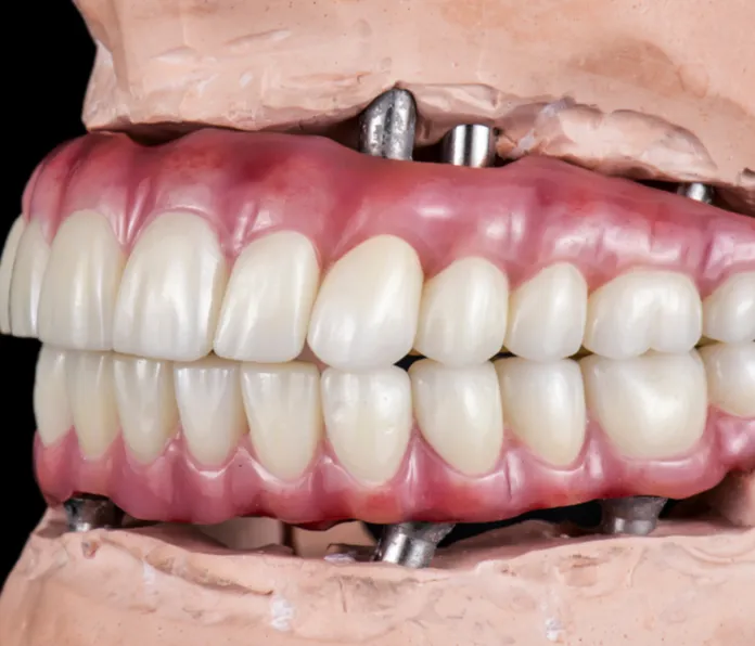 Full Mouth Implants