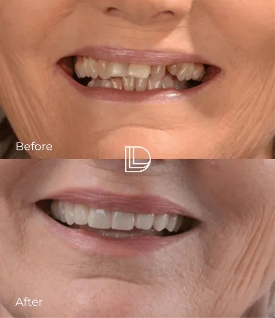 Happy client with dental implant in Osborne Park