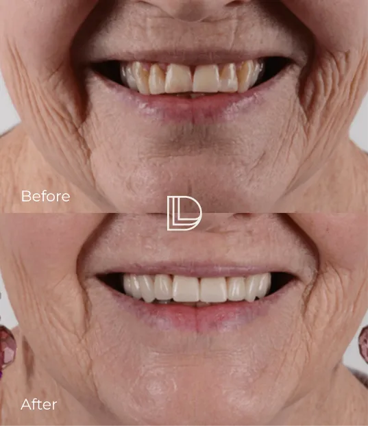 dental veneers in Osborne Park
