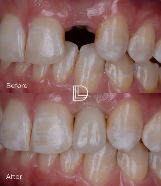 single tooth implant in Osborne Park