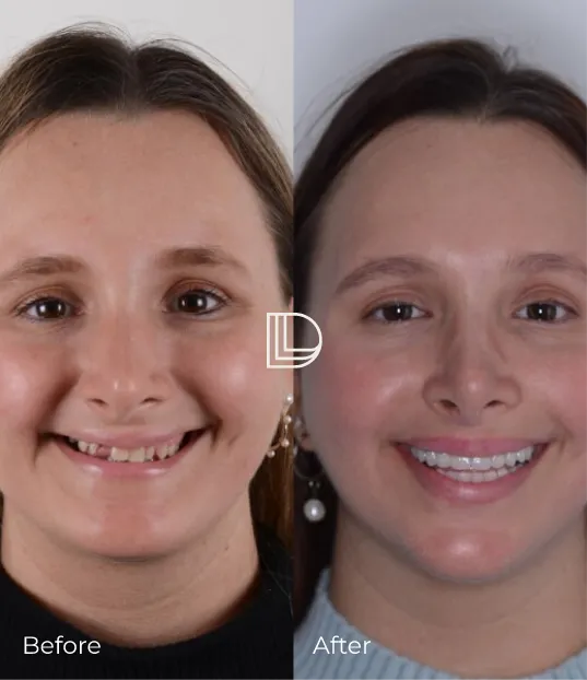 dental veneers before after transformation