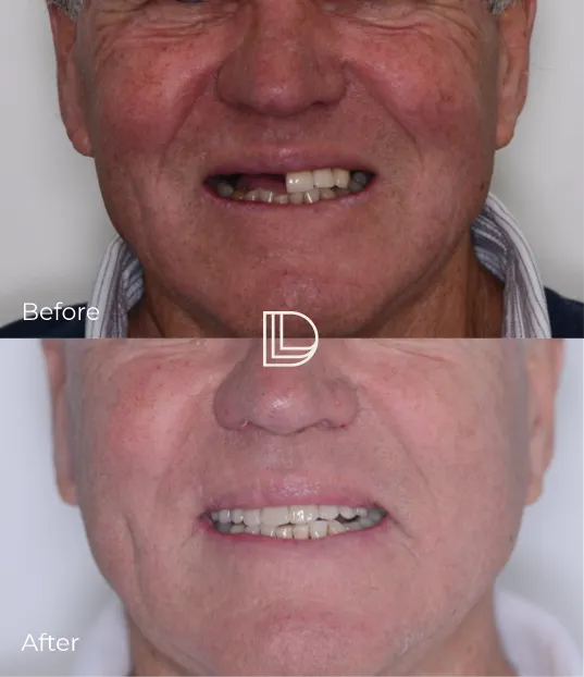 Before after transformation - dental implant