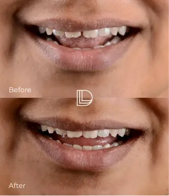 Teeth whitening in Osborne Park.