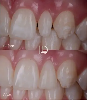 Dental Fillings at Osborne Park