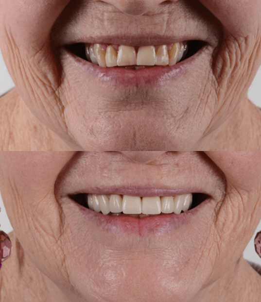 Cosmetic dental transformation