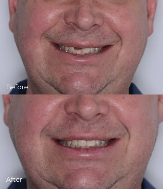 dental-implants1
