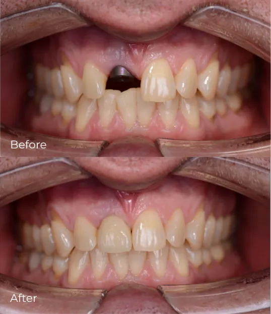 dental-implants2