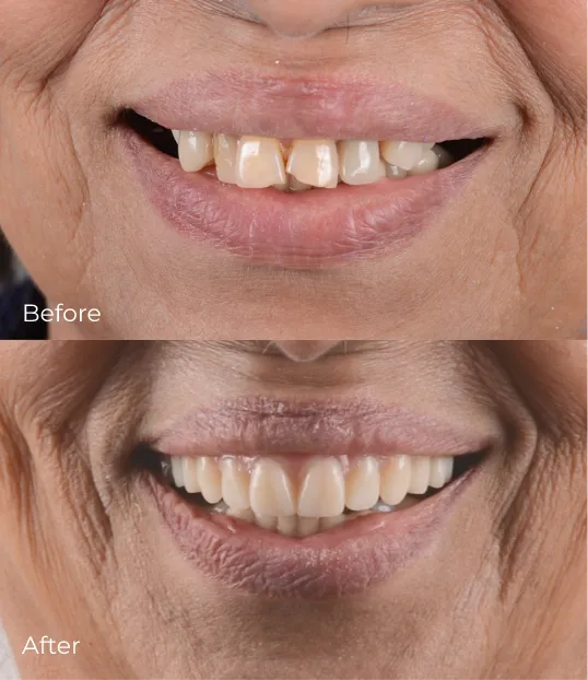 dental-implants4
