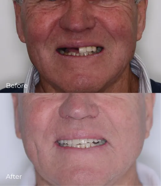 dental-implants5