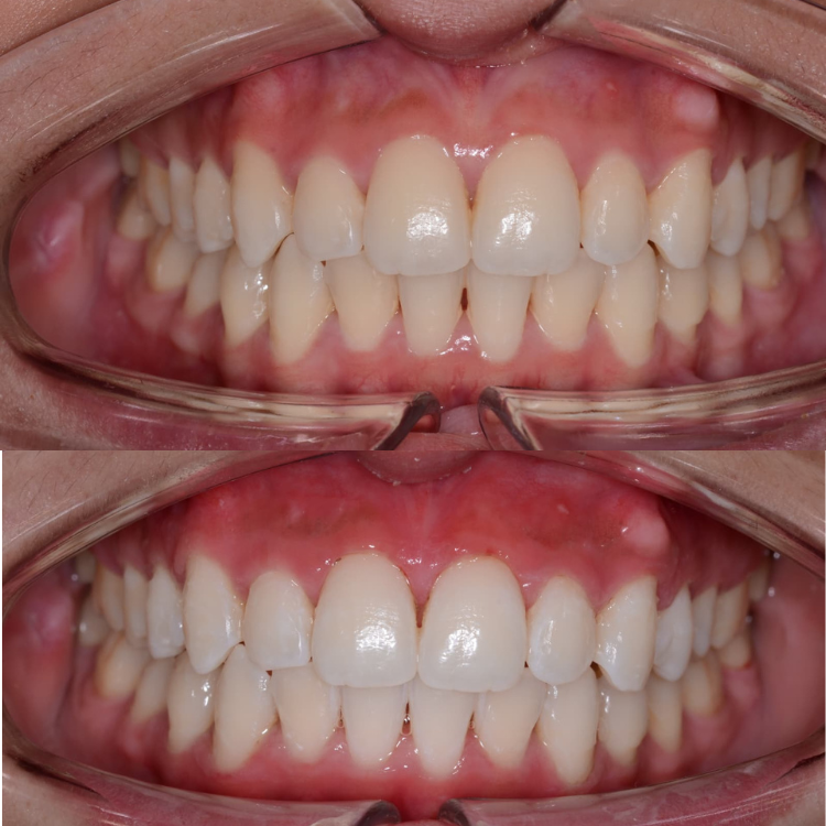 Teeth Whitening osborne park