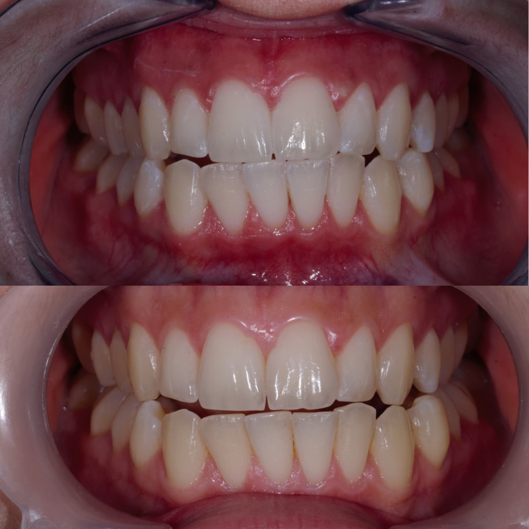 Teeth Whitening in osborne park